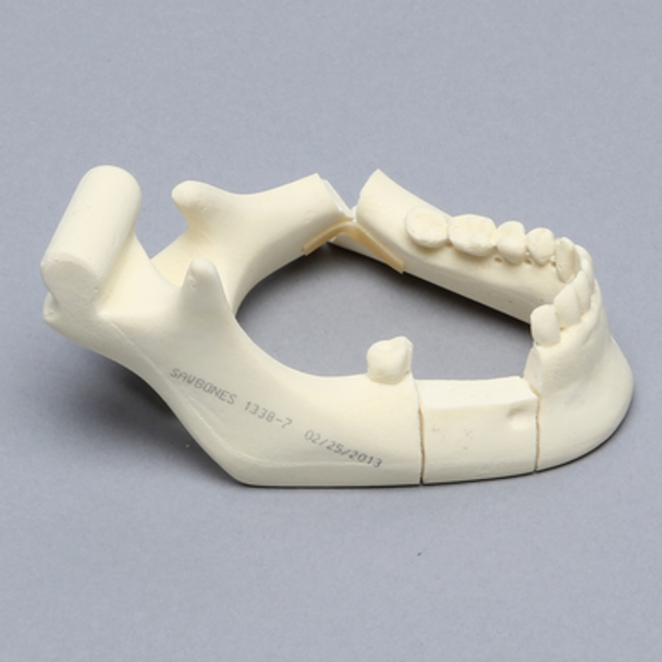 Mandible with Bilateral Fractures
