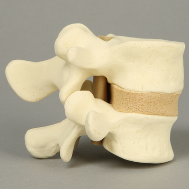 Lumbar Vertebrae, L4-L5, with Stenosis, Solid Foam