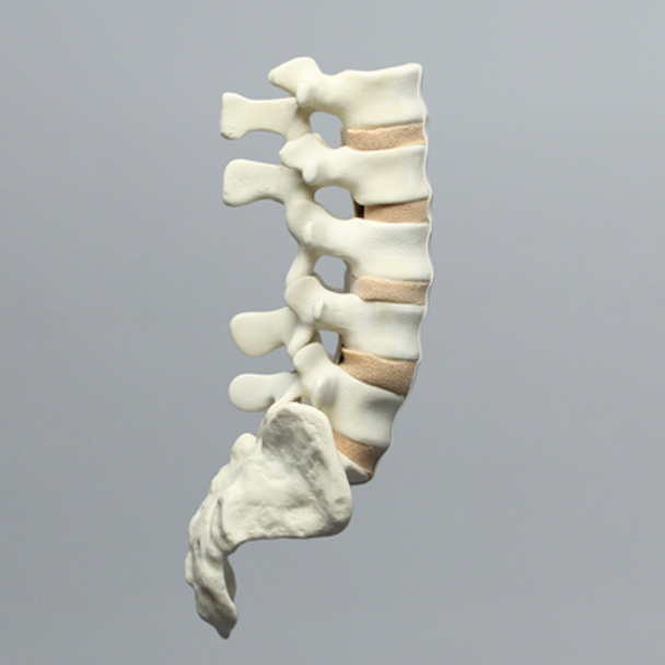 Spine, Lumbar with Laminectomy, Solid Foam