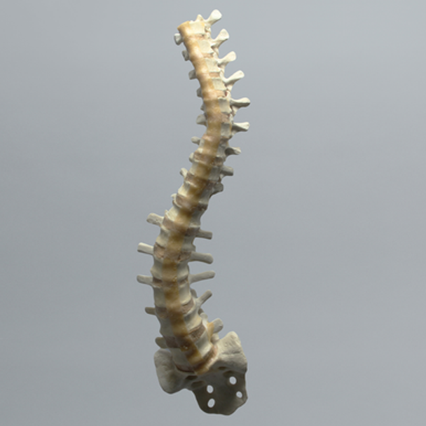 Spine, Scoliosis, T3-Sacrum, Foam Cortical