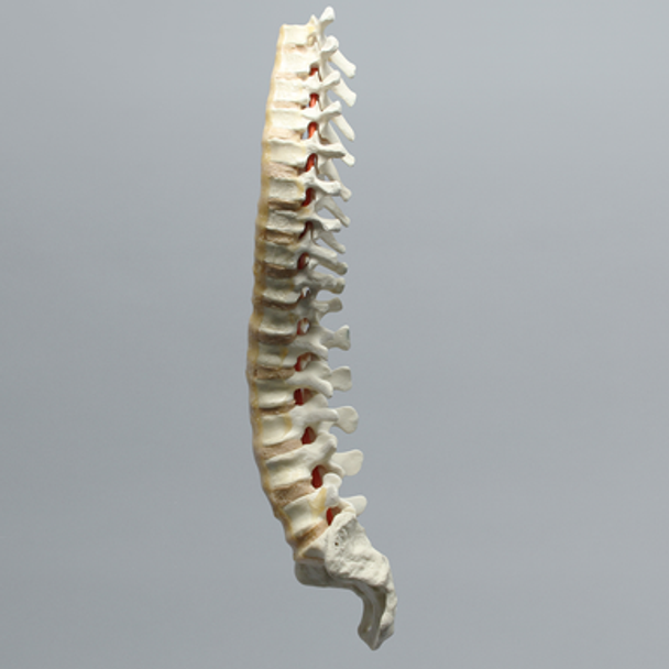 Spine, Scoliosis, T3-Sacrum, Foam Cortical