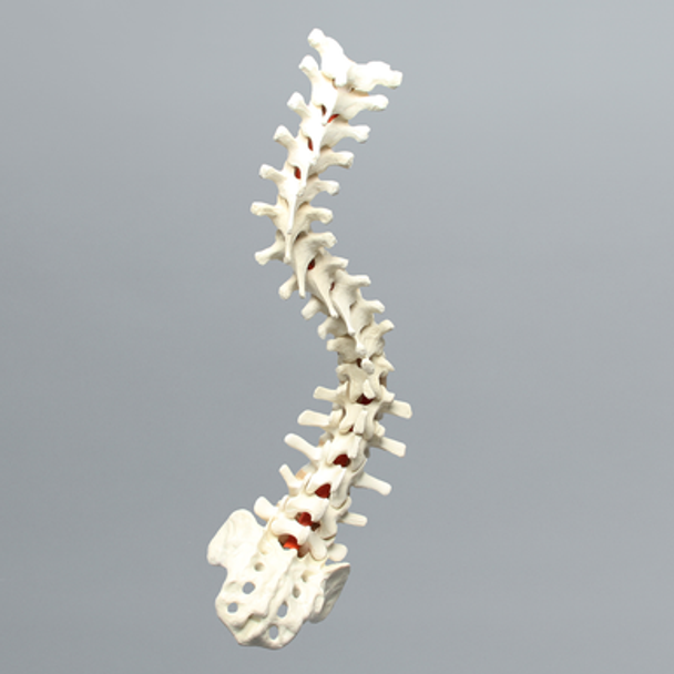 Spine, Scoliosis, T1-Sacrum with 15 degree Rotation, Solid Foam