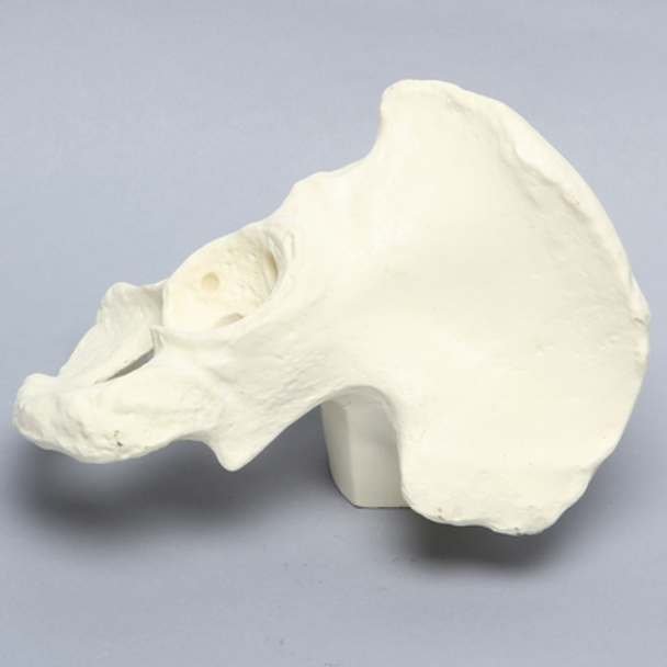 Hemi Pelvis with Bone Loss, Solid Foam, Left