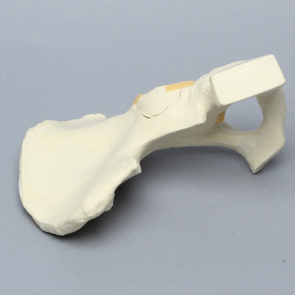Hemi Pelvis with Wall Fractures, Solid Foam, Right