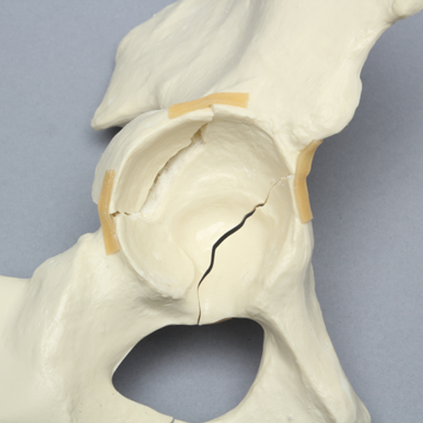 Hemi Pelvis with Wall Fractures, Solid Foam, Right