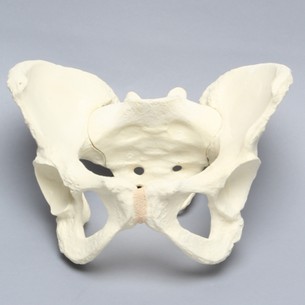 Pelvis with Dysplasia, Full Female, Solid Foam