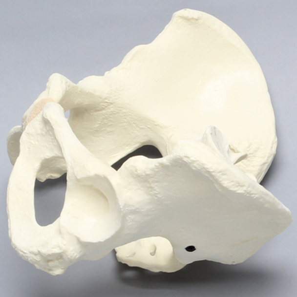 Pelvis with Dysplasia, Full Female, Solid Foam