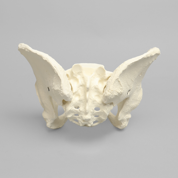 Pelvis with Dysplasia, Full Female, Solid Foam