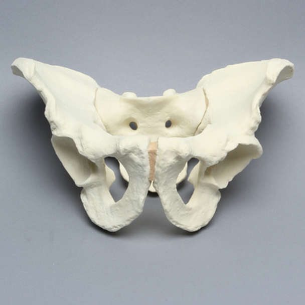 Pelvis with Osteoarthritic Acetabulum, Full Male, Solid Foam