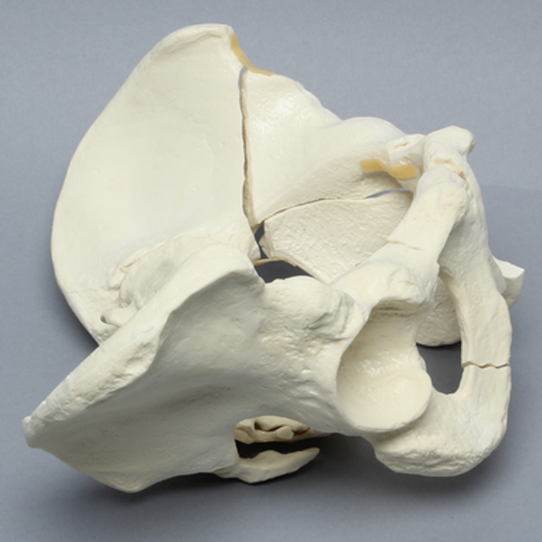 Pelvis with Sacral, Acetabular, and Column Fractures, Full Male, Foam Cortical