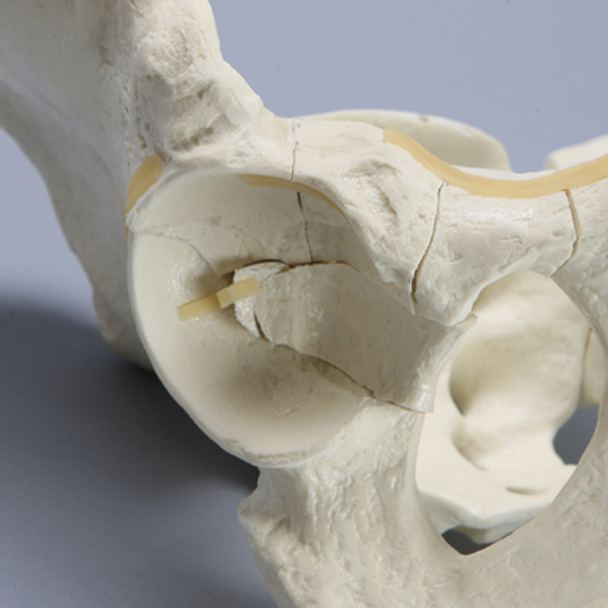 Pelvis with Fractures, Full Male, Foam Cortical
