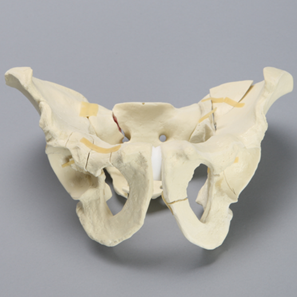Pelvis with Fractures, Full Male, Foam Cortical