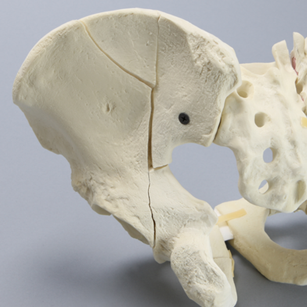 Pelvis with Fractures, Full Male, Foam Cortical