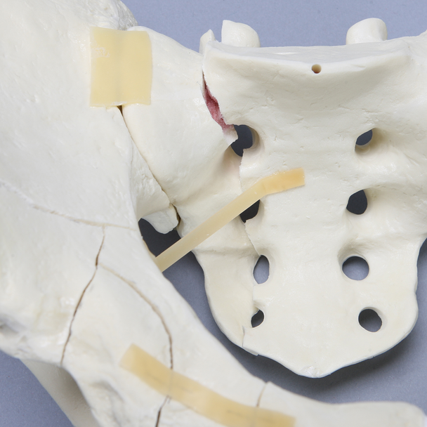 Pelvis with Fractures, Full Male, Foam Cortical
