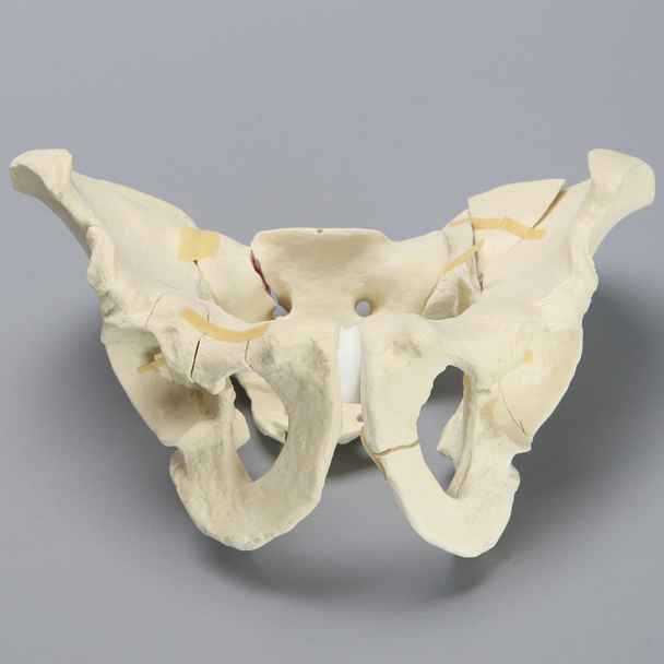Pelvis with Fractures, Full Male, Foam Cortical