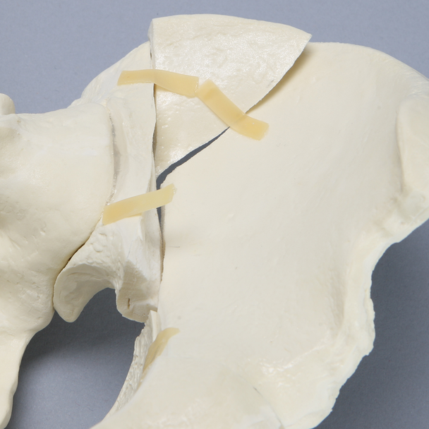 Pelvis with Fractures, Full Male, Foam Cortical