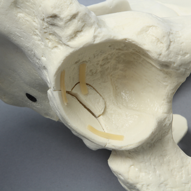 Pelvis with Posterior Wall Fracture, Full Male, Foam Cortical