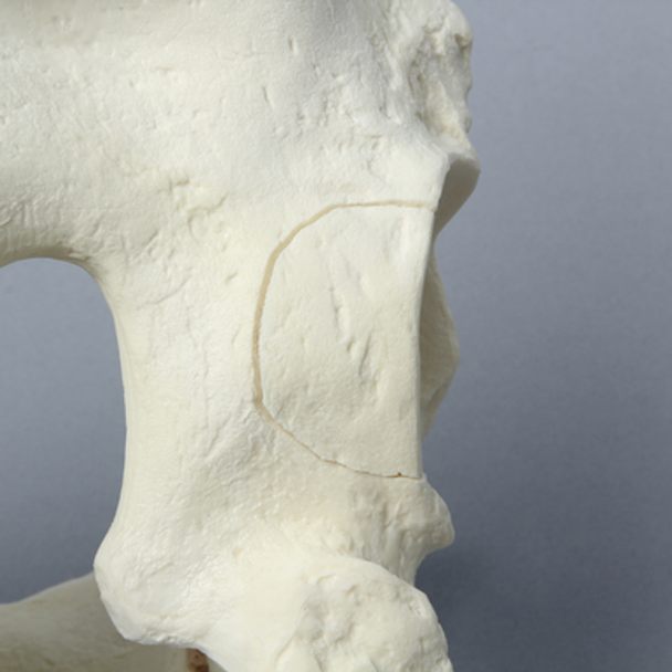 Pelvis with Posterior Wall Fracture, Full Male, Foam Cortical