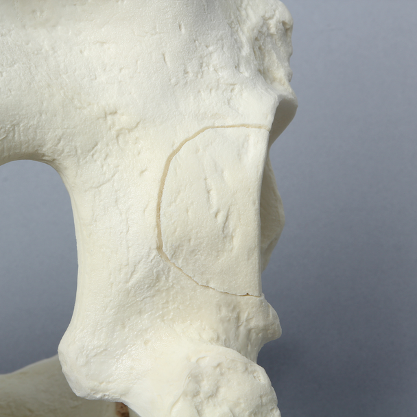 Pelvis with Posterior Wall Fracture, Full Male, Foam Cortical