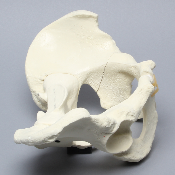 Pelvis with Acetabular Fractures, Full Male, Foam Cortical