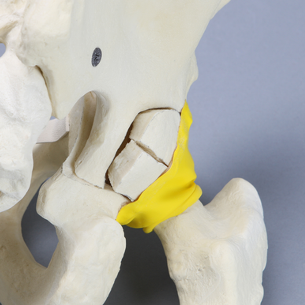 Pelvis with Acetabular Fractures, Fragment, and Femur, Full Male