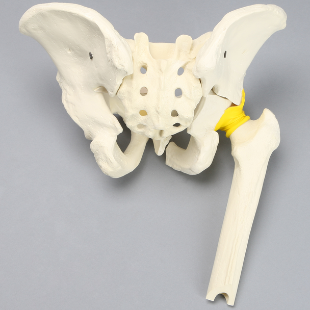 Pelvis with "T" Fracture, Displacement, and Encapsulated Femur, Full Male