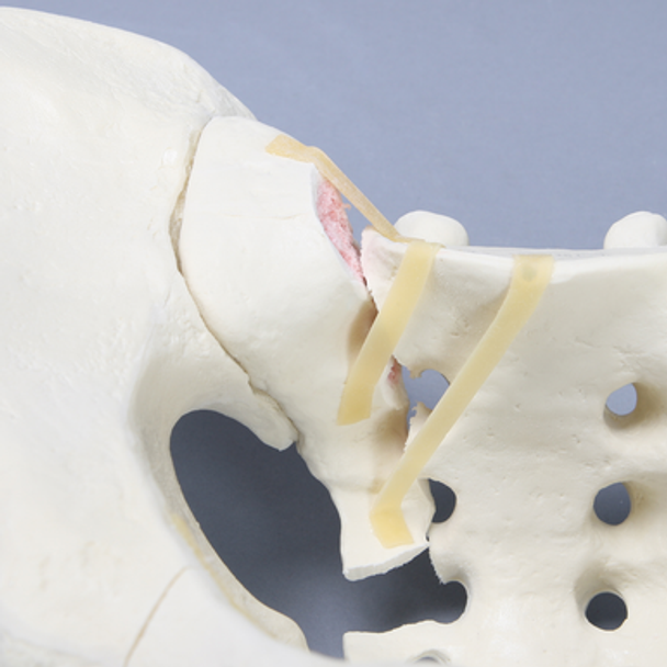Pelvis with Sacral and Rami Fractures with Displacement, Full Male, Foam Cortical