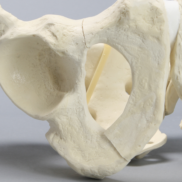 Pelvis with Sacral and Rami Fractures with Displacement, Full Male, Foam Cortical