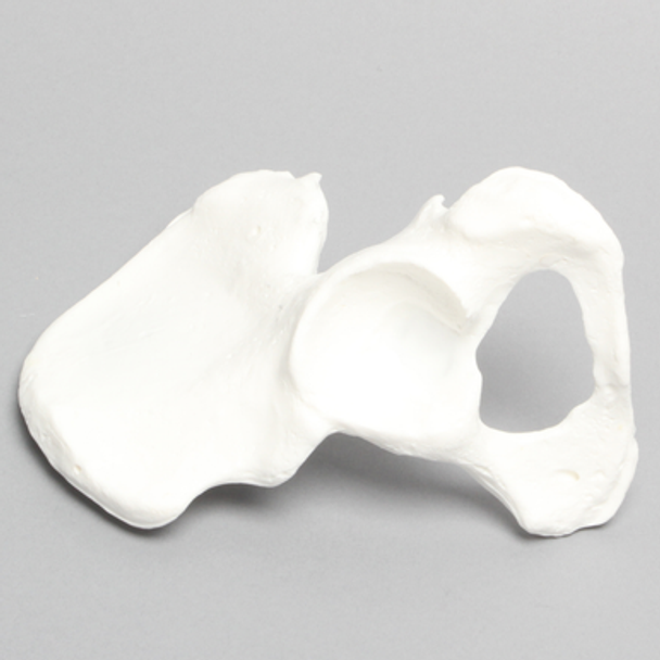 Hemi Pelvis, Female, Solid Foam, With Dysplasia, Left