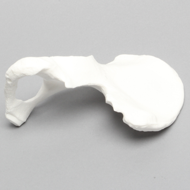 Hemi Pelvis, Female, Solid Foam, With Dysplasia, Left