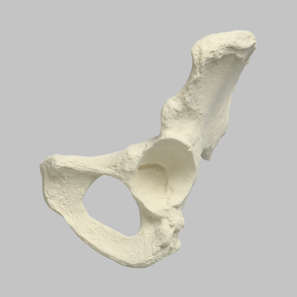 Hemi Pelvis, Female, Solid Foam, With Dysplasia, Left