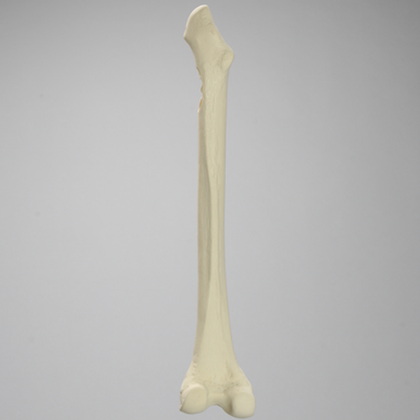 Femur with Segmental Defect and Perforated Wall
