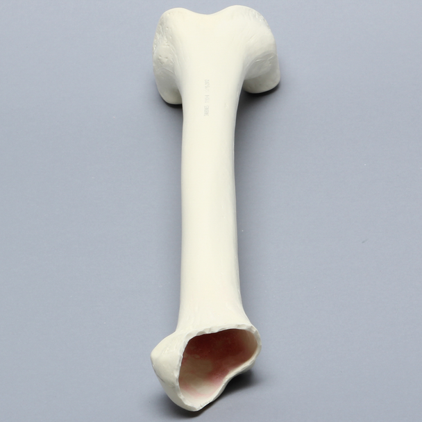 Femur with Focal Deficiency Type 2