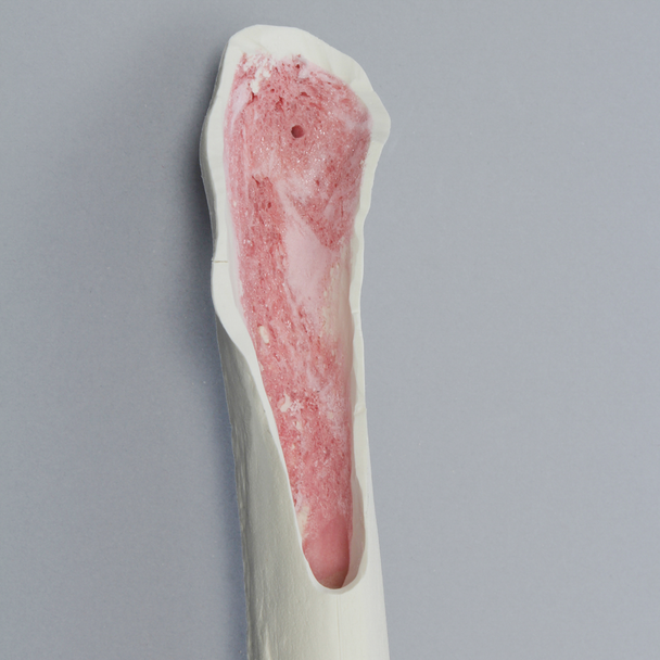 Femur with Cortex Wall Loss