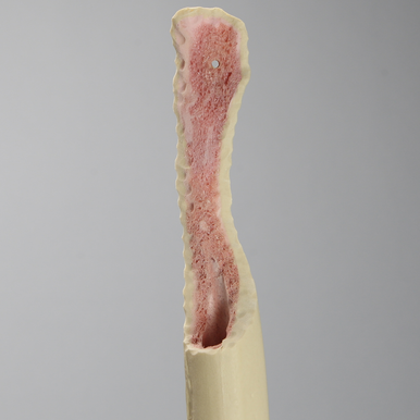 Femur with Focal Deficiency Type 4