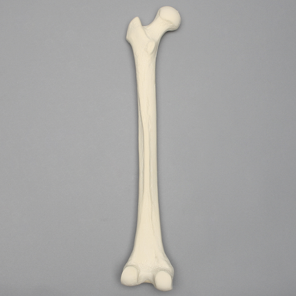Femur with 135 Degree Neck Deformity