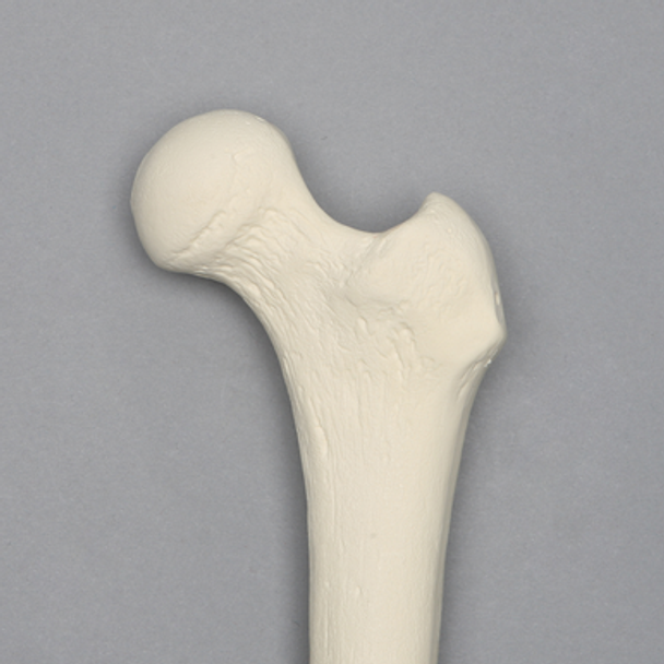 Femur with 135 Degree Neck Deformity