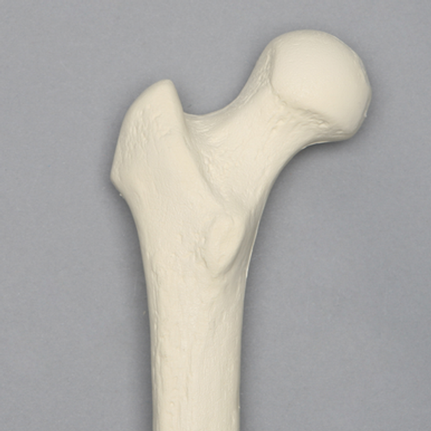 Femur with 135 Degree Neck Deformity