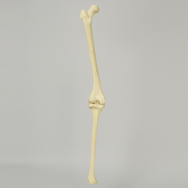 Knee with Distal Femur 10 Degree Valgus Deformity