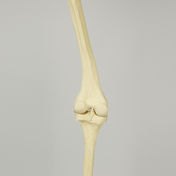 Knee with Distal Femur 10 Degree Valgus Deformity