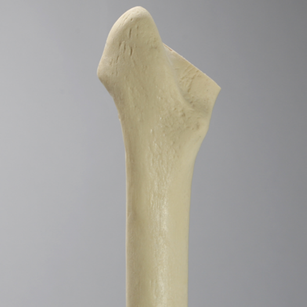 Femur with Broached Proximal Cavity and Midshaft Plug