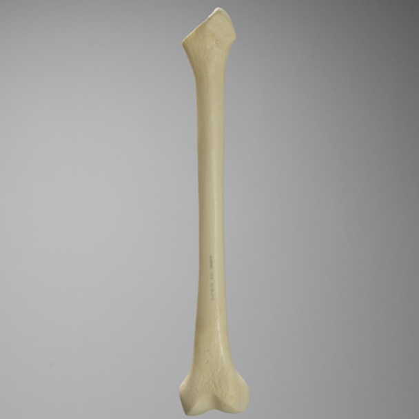 Femur with Broached Proximal Cavity and Midshaft Plug