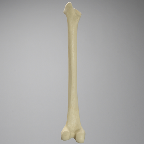 Femur with Broached Proximal Cavity and Midshaft Plug
