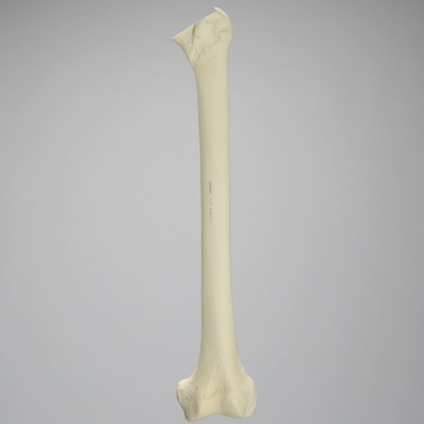 Femur with Broached and Cemented Proximal Cavity