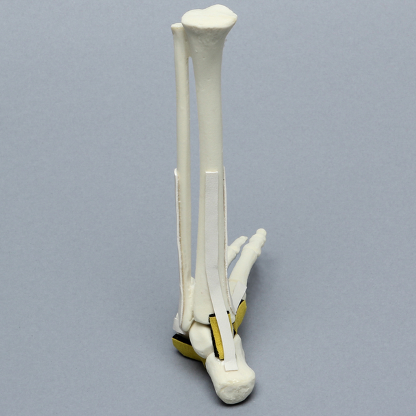 Foot and Ankle, with Clubfoot and Ligaments, Pediatric