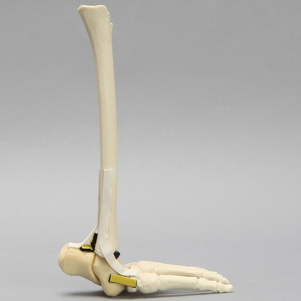 Foot and Ankle with Vertical Talus Pathology, Pediatric