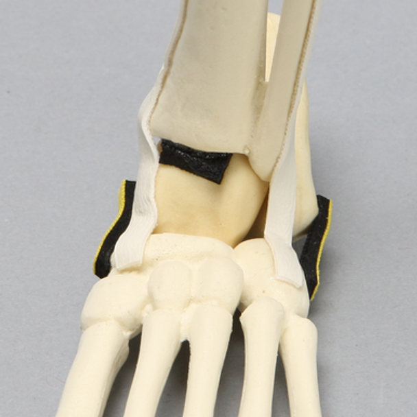 Foot and Ankle with Vertical Talus Pathology, Pediatric