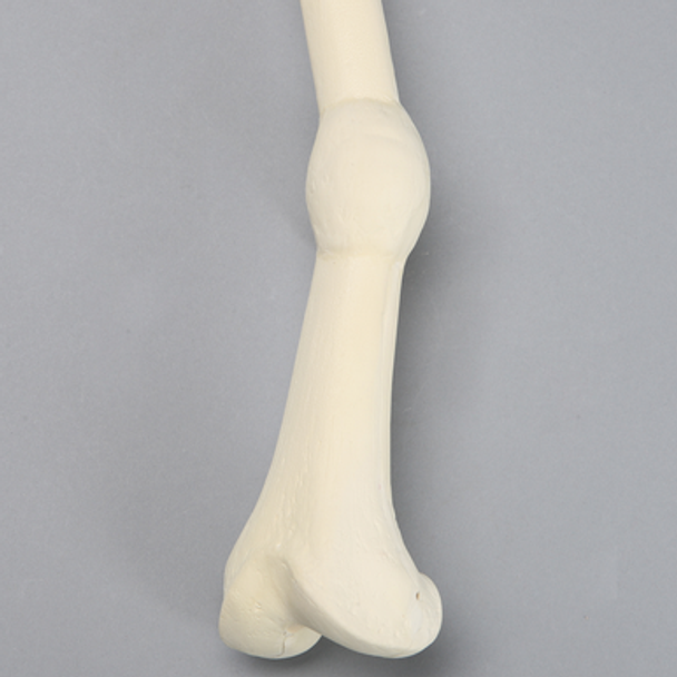 Femur with Distal Malunion and 35 Degree Rotation