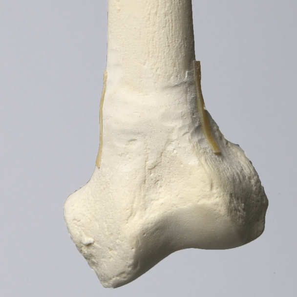 Femur with 10 Degree Valgus Deformity