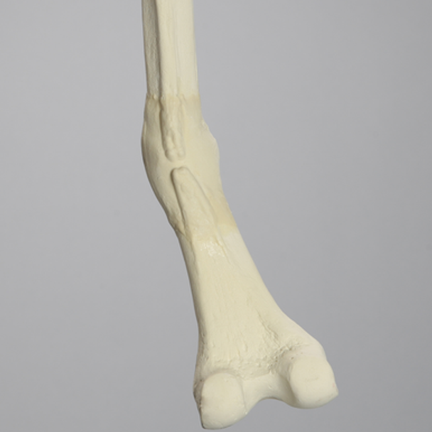 Femur with Distal Malunion and 45 Degree Rotation